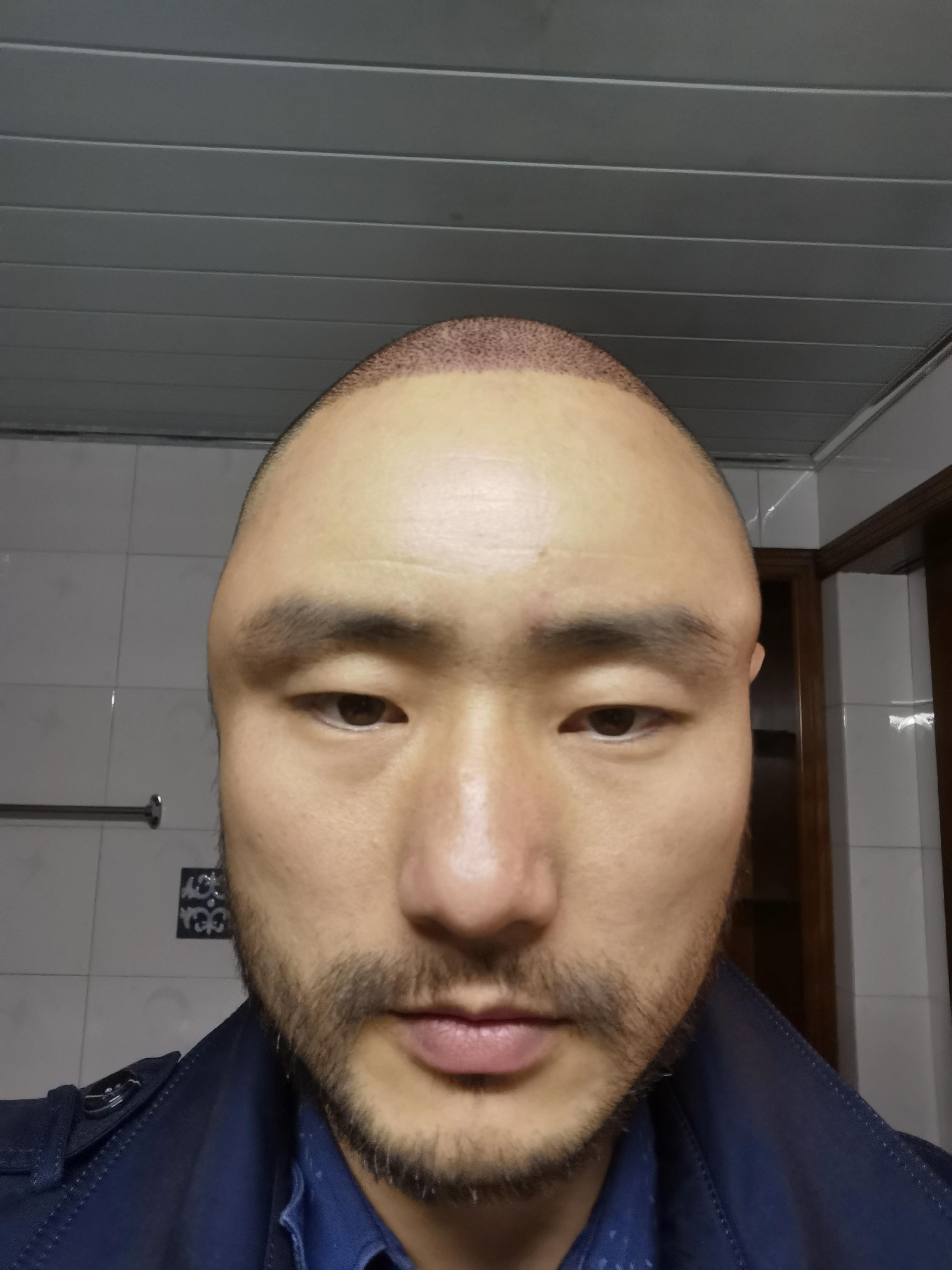 探寻最佳植发医院，上海植发医院哪家好？