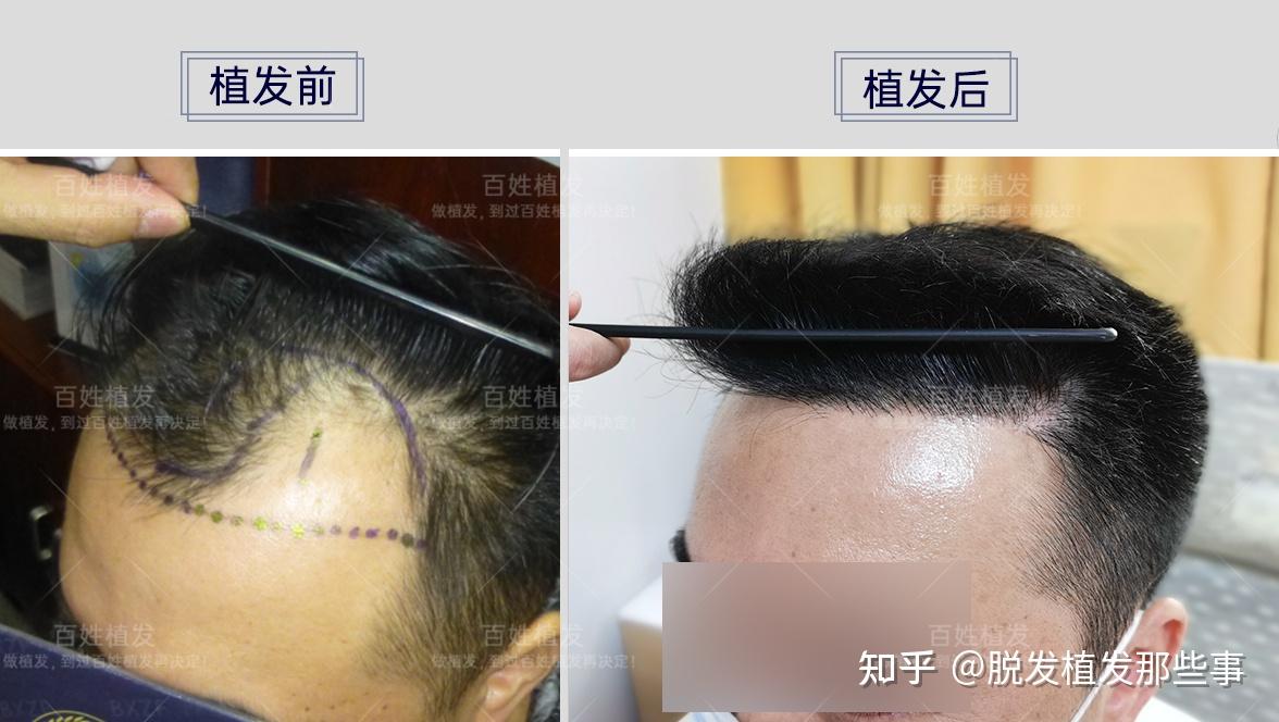 成都植发选择，探寻最佳植发机构与方案