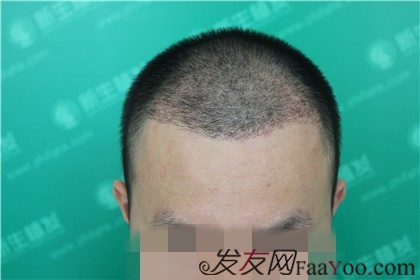 北京无痕植发，重塑自信的头发之美